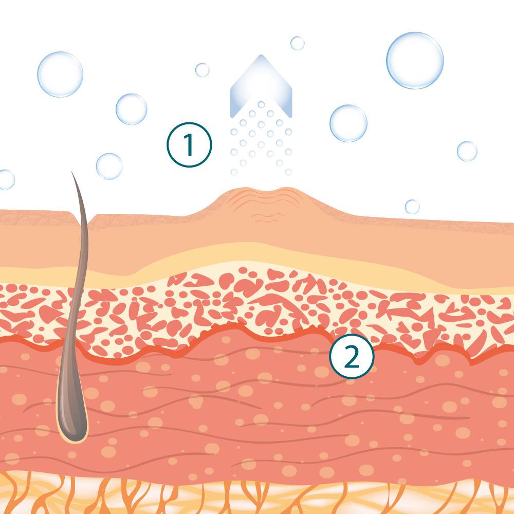 Silimed Scar Treatment Mechanism of Action 1st stage