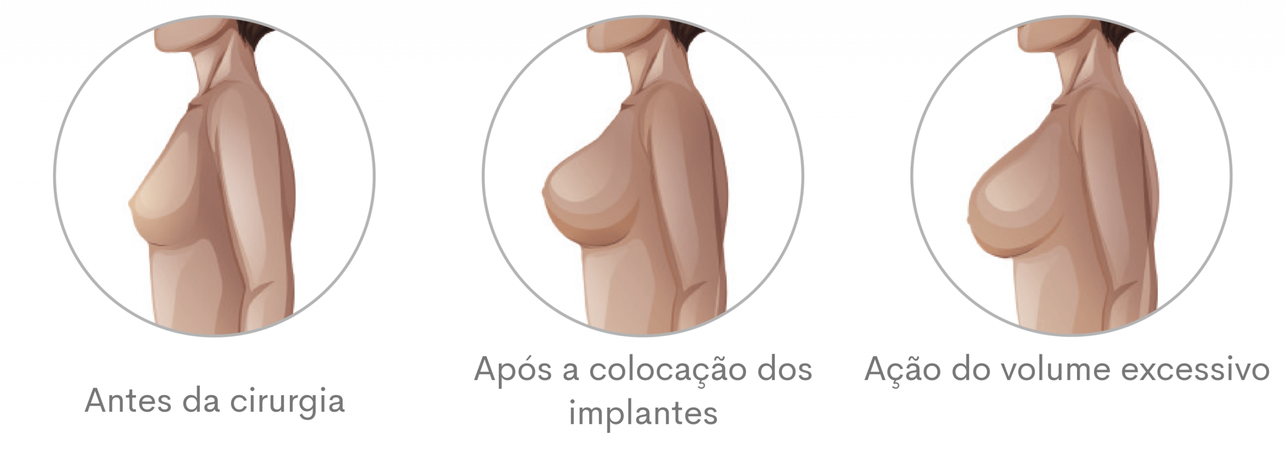 Silimed Implante Mamário Linha Biodesign Dimensões